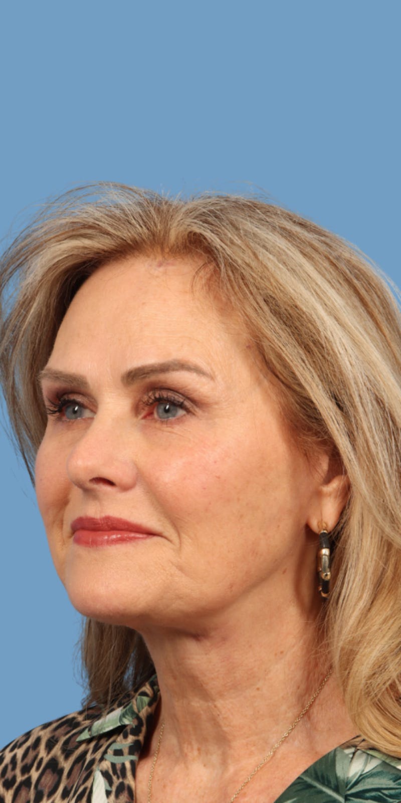 Facelift Before & After Gallery - Patient 196605 - Image 2