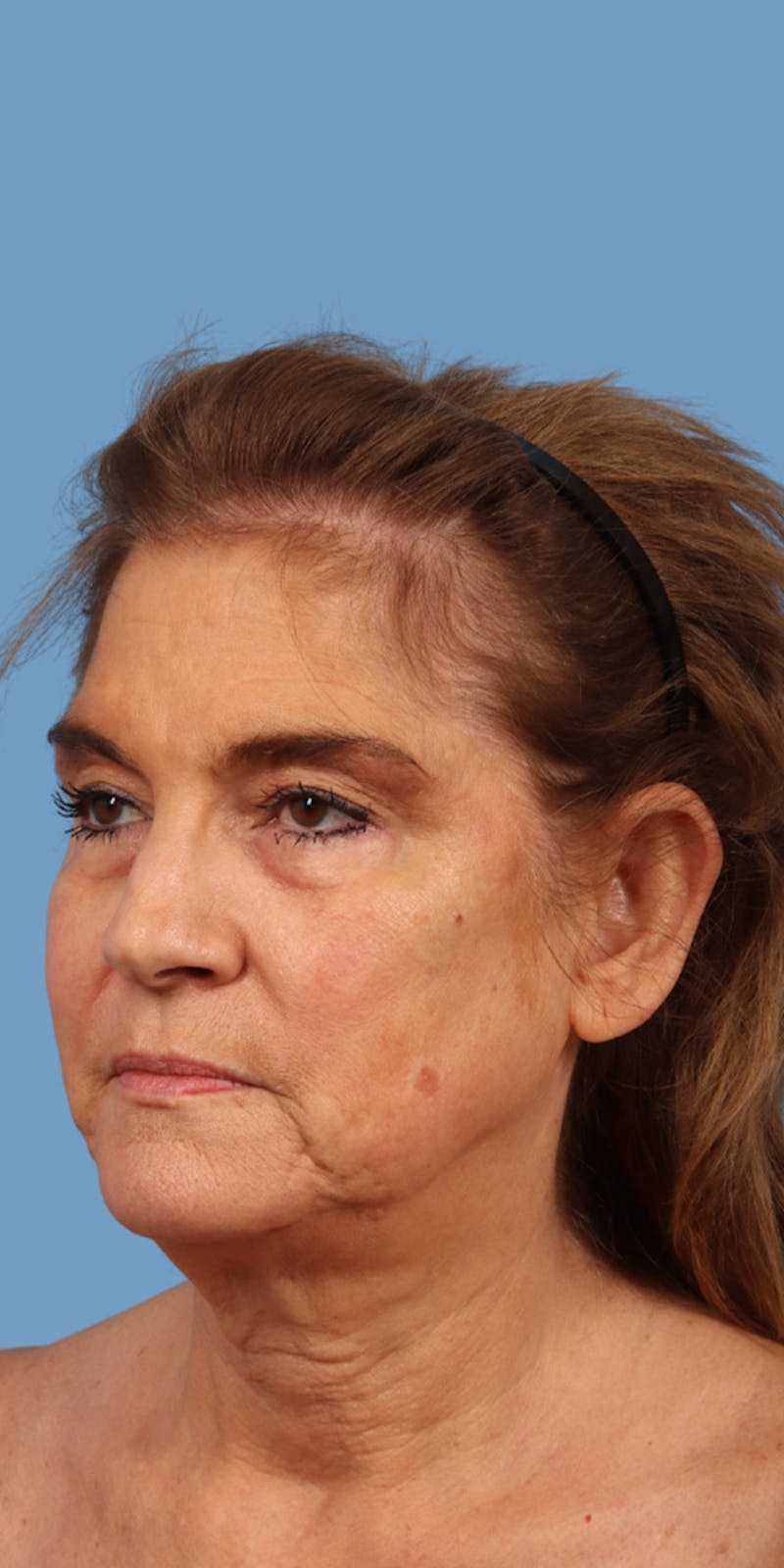 Facelift Before & After Gallery - Patient 425849 - Image 1