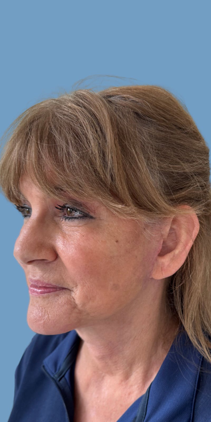 Facelift Before & After Gallery - Patient 425849 - Image 2