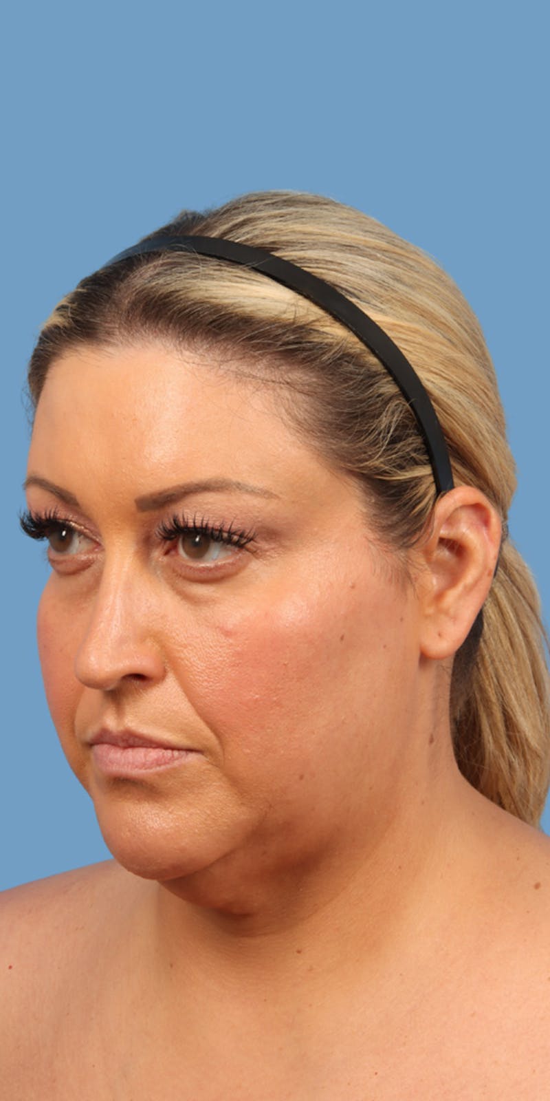 Facelift Before & After Gallery - Patient 193166 - Image 1
