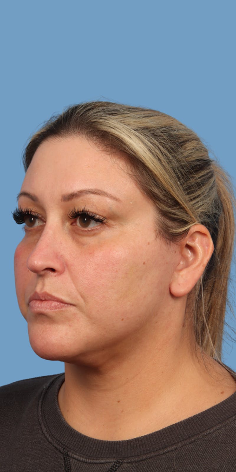 Facelift Before & After Gallery - Patient 193166 - Image 2
