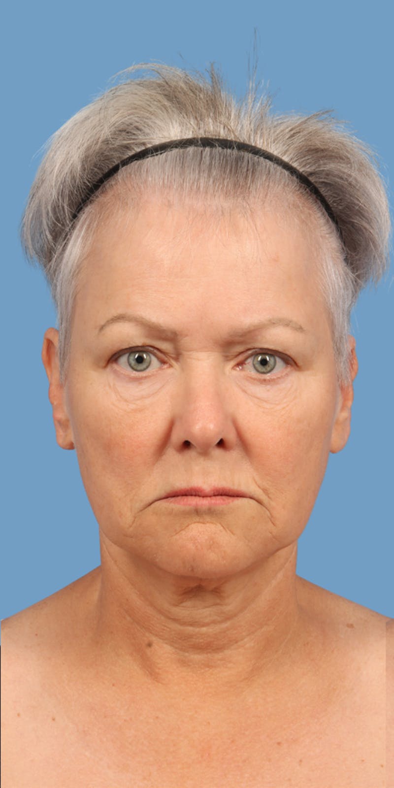 Facelift Before & After Gallery - Patient 220716 - Image 1