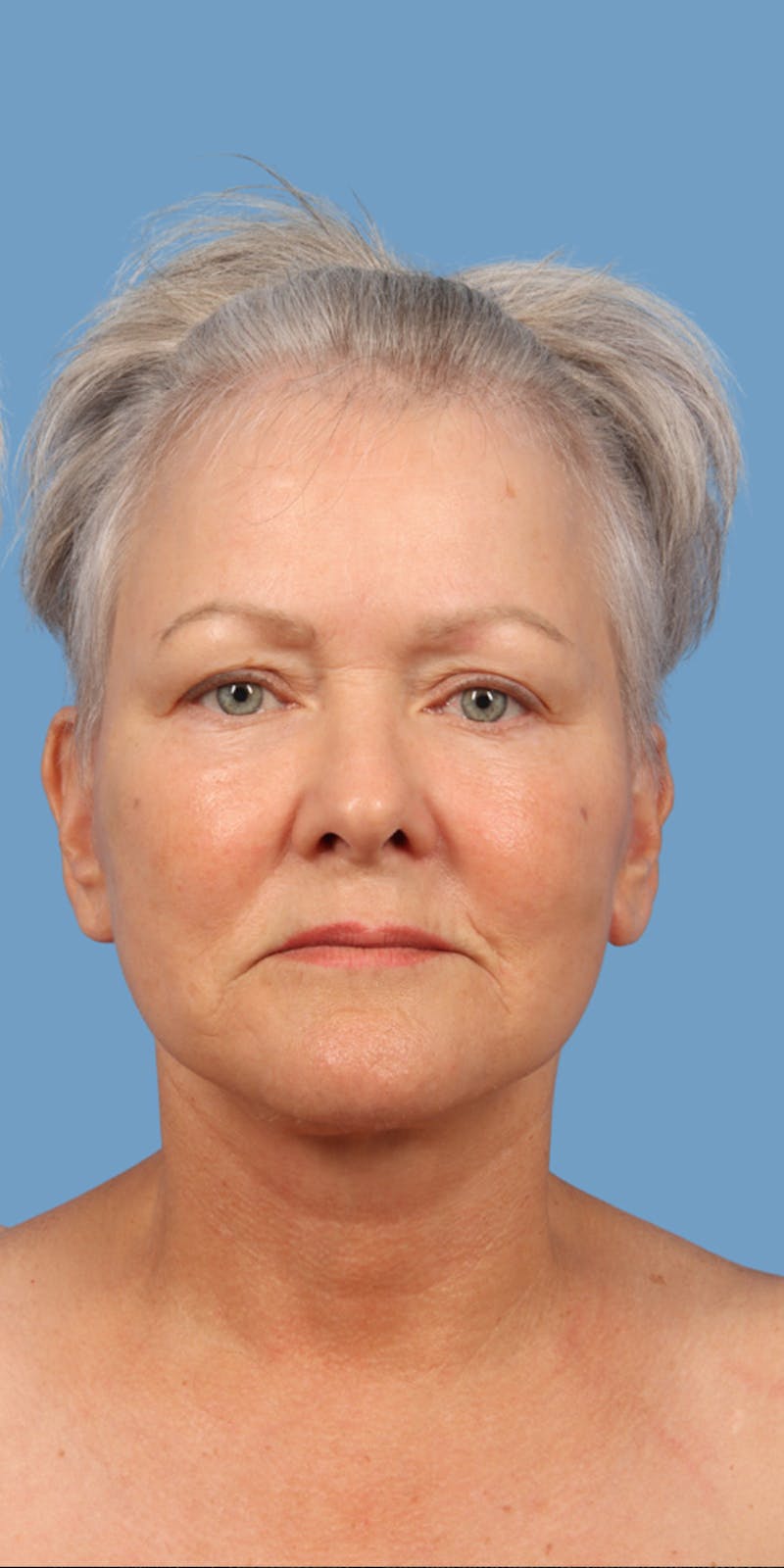 Facelift Before & After Gallery - Patient 220716 - Image 2
