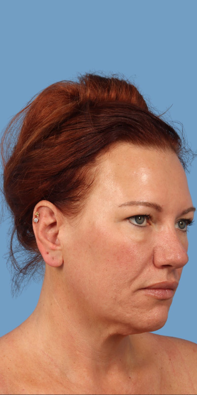 Facelift Before & After Gallery - Patient 219163 - Image 1