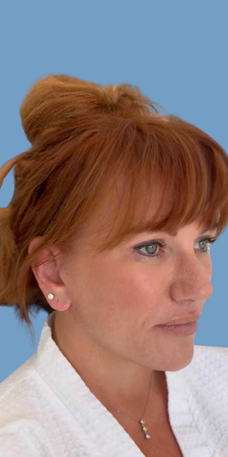 Facelift Before & After Gallery - Patient 219163 - Image 2
