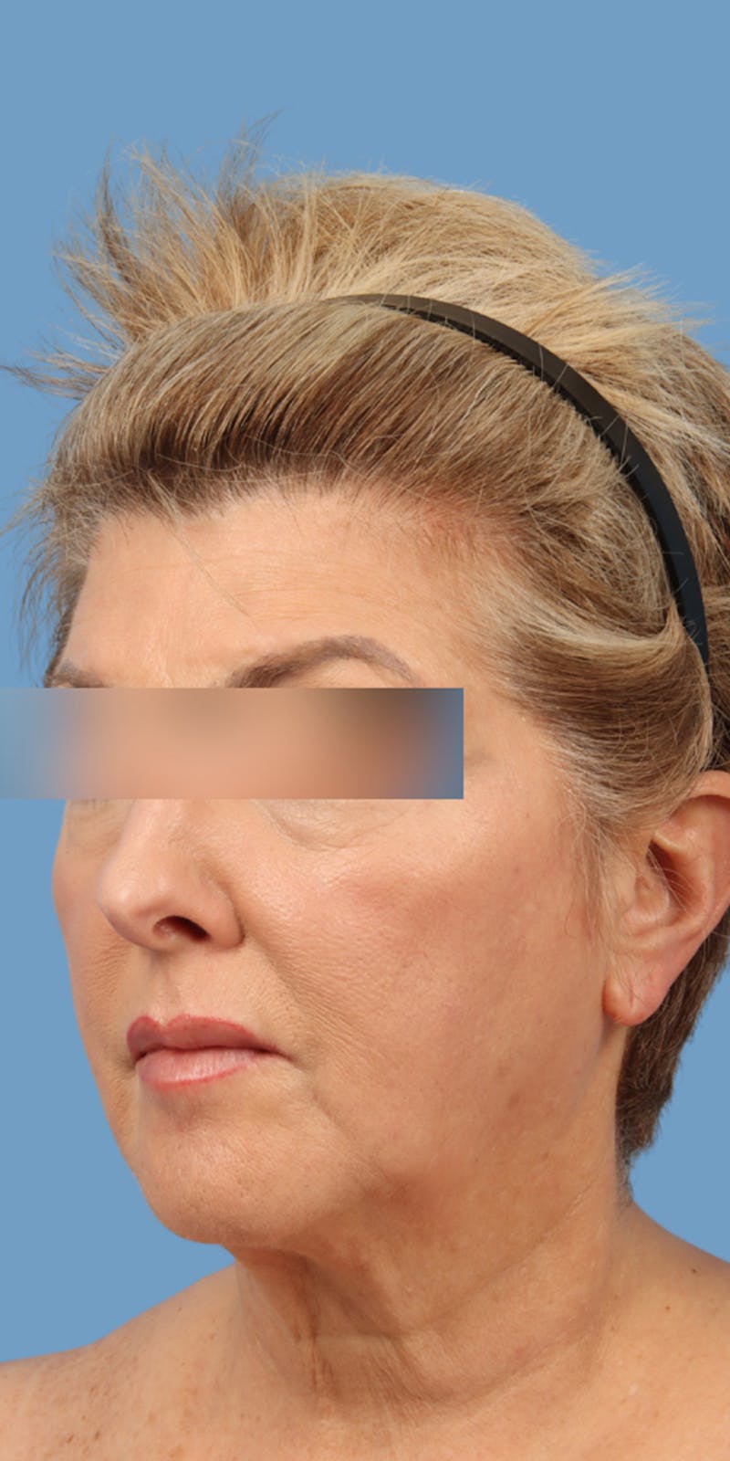 Facelift Before & After Gallery - Patient 121544 - Image 1