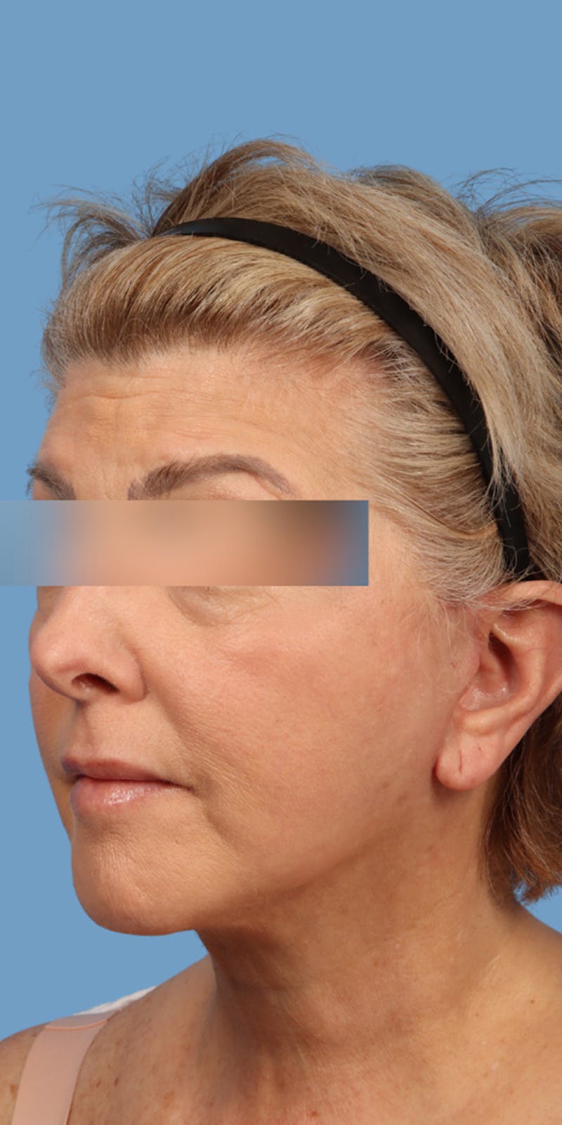Facelift Before & After Gallery - Patient 121544 - Image 2
