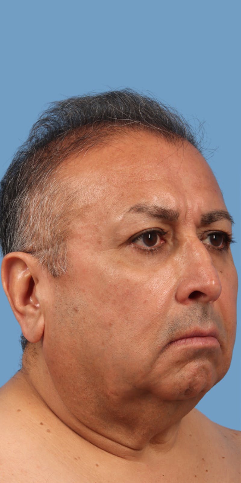 Facelift Before & After Gallery - Patient 222130 - Image 1