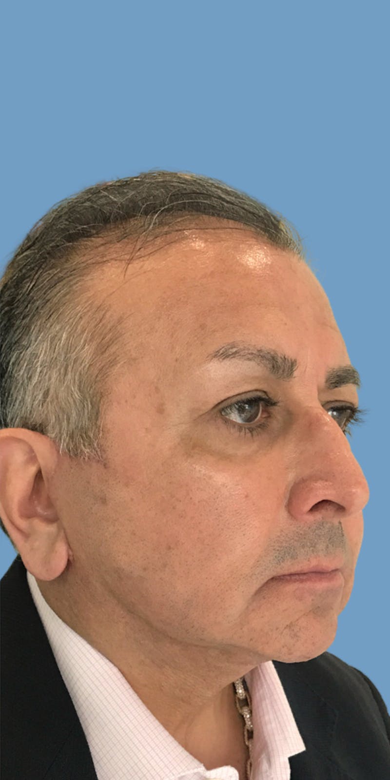 Facelift Before & After Gallery - Patient 222130 - Image 2