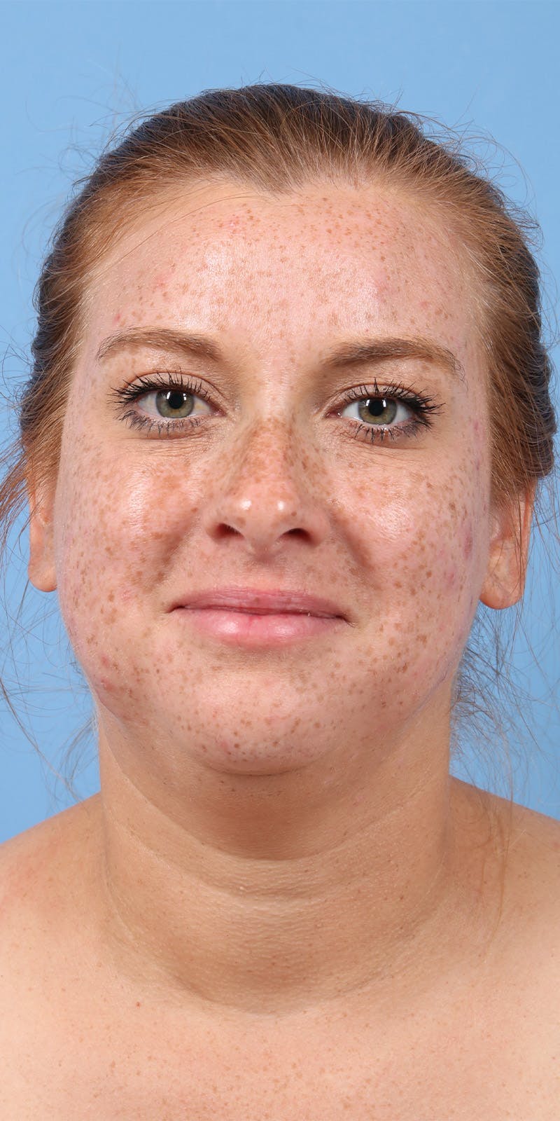 Facelift Before & After Gallery - Patient 179644 - Image 3