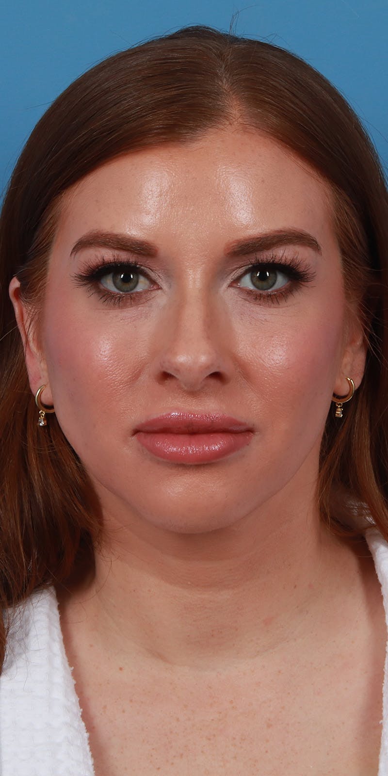 Facelift Before & After Gallery - Patient 179644 - Image 4