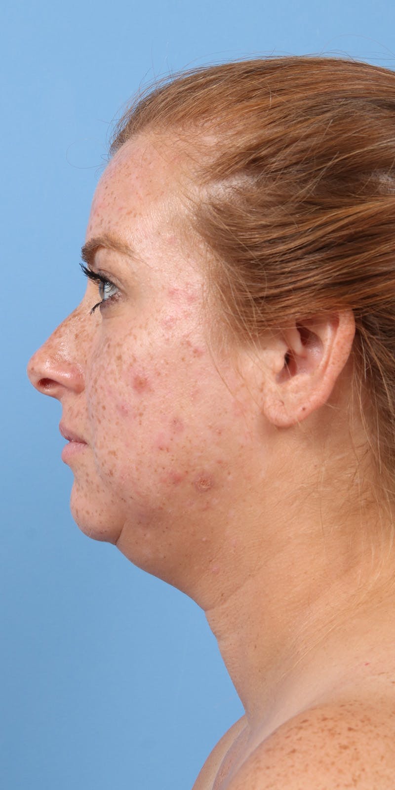 Facelift Before & After Gallery - Patient 179644 - Image 5