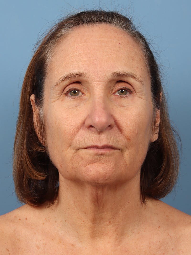 Neck Lift Before & After Gallery - Patient 162886 - Image 5