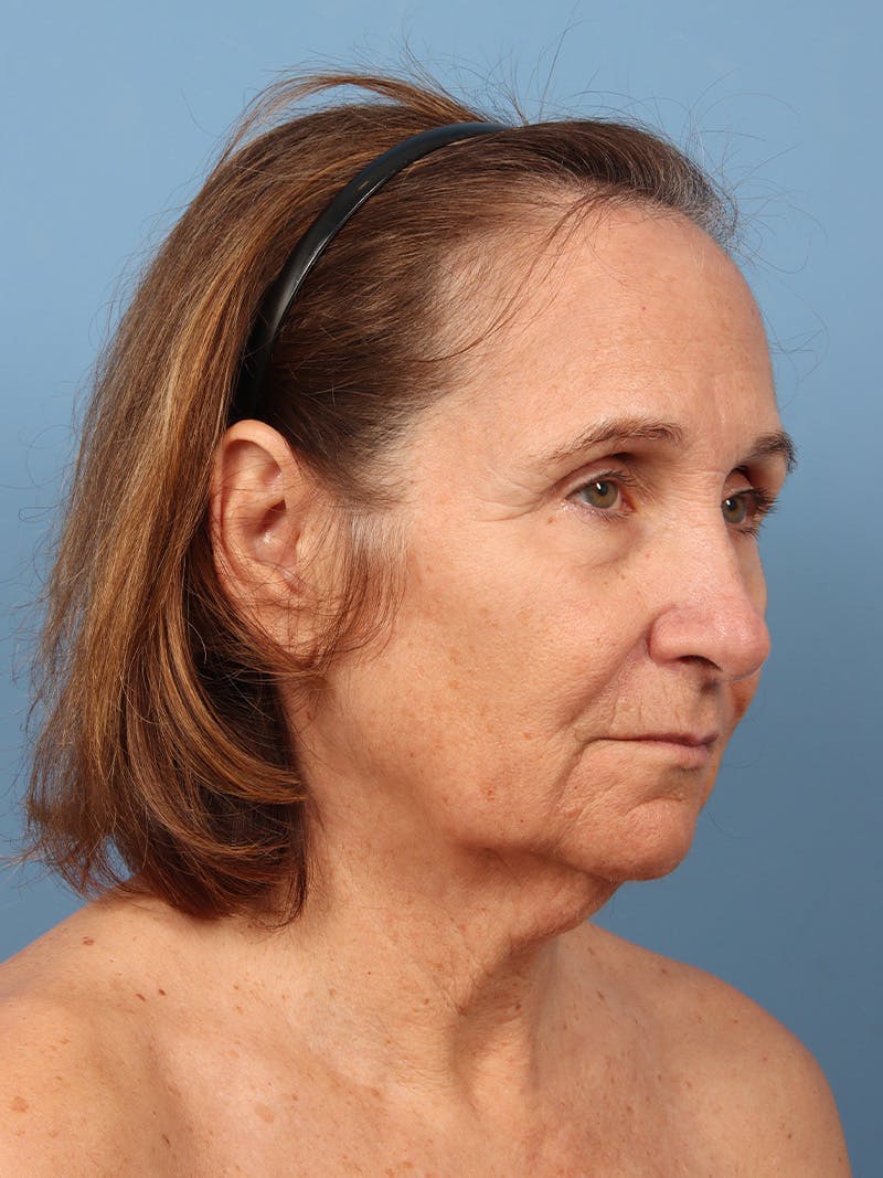 Neck Lift Before & After Gallery - Patient 162886 - Image 1