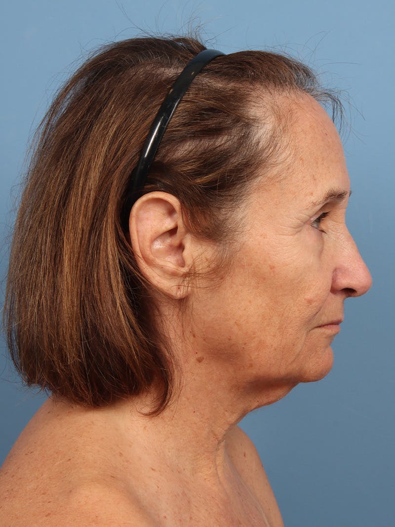 Neck Lift Before & After Gallery - Patient 162886 - Image 3