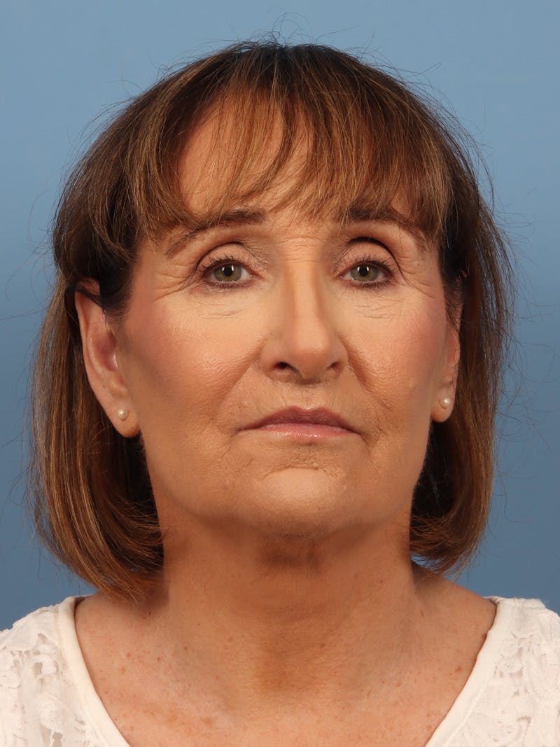 Neck Lift Before & After Gallery - Patient 162886 - Image 6