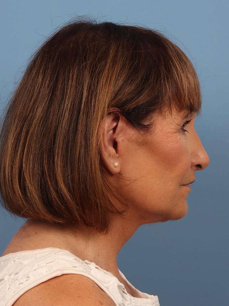 Neck Lift Before & After Gallery - Patient 162886 - Image 4