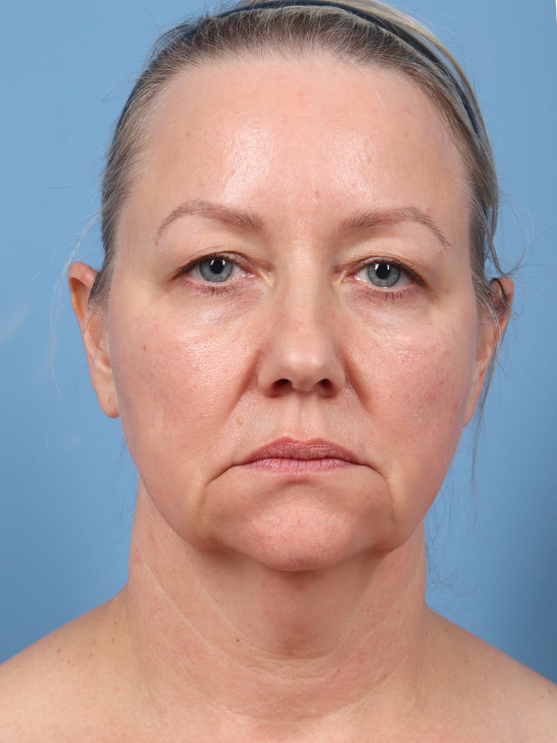 Facelift Before & After Gallery - Patient 342939 - Image 5