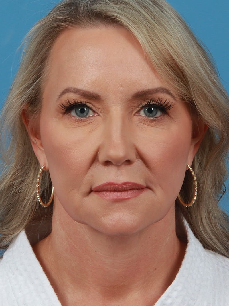 Facelift Before & After Gallery - Patient 342939 - Image 6