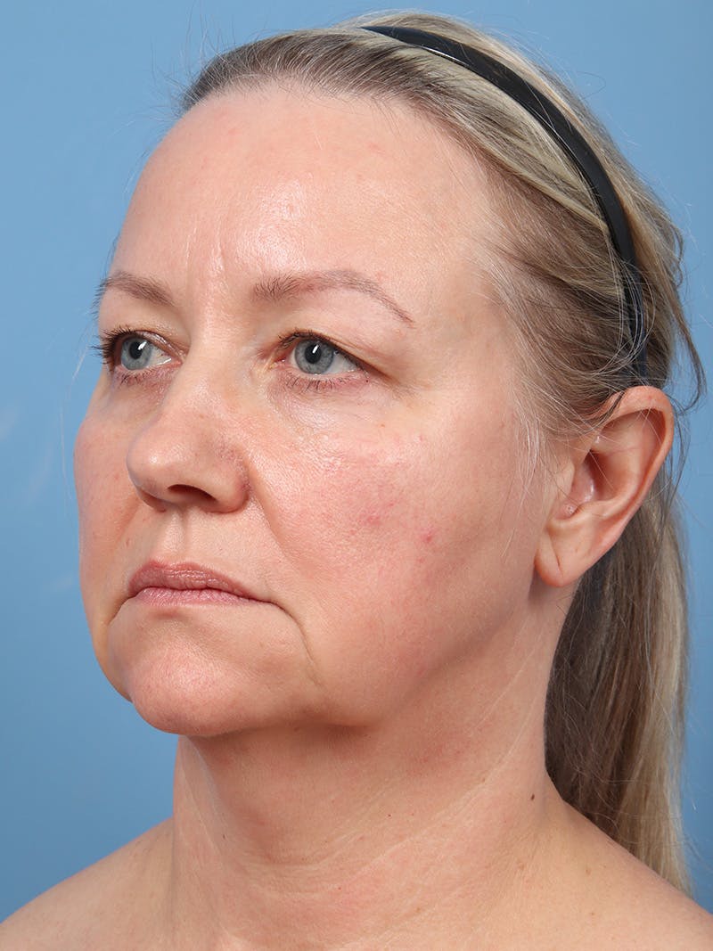 Facelift Before & After Gallery - Patient 342939 - Image 1