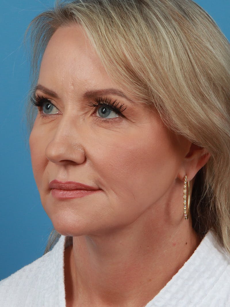 Facelift Before & After Gallery - Patient 342939 - Image 2