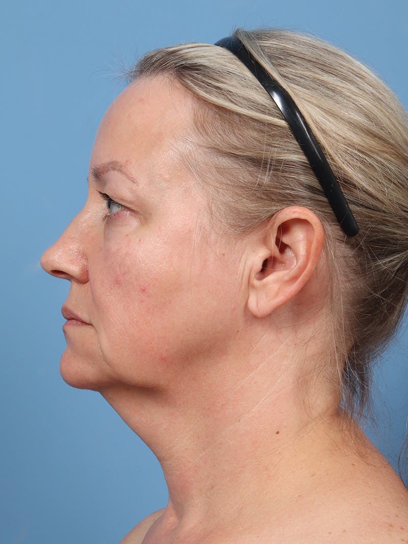 Facelift Before & After Gallery - Patient 342939 - Image 3