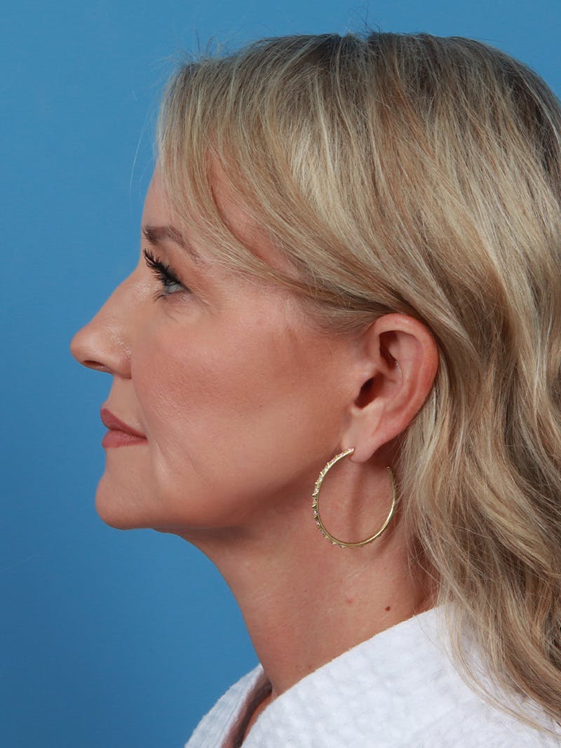 Facelift Before & After Gallery - Patient 342939 - Image 4