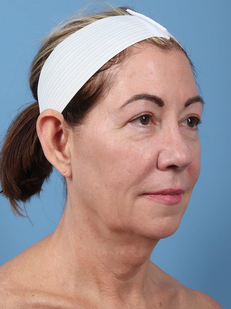 Neck Lift Before & After Gallery - Patient 747437 - Image 1