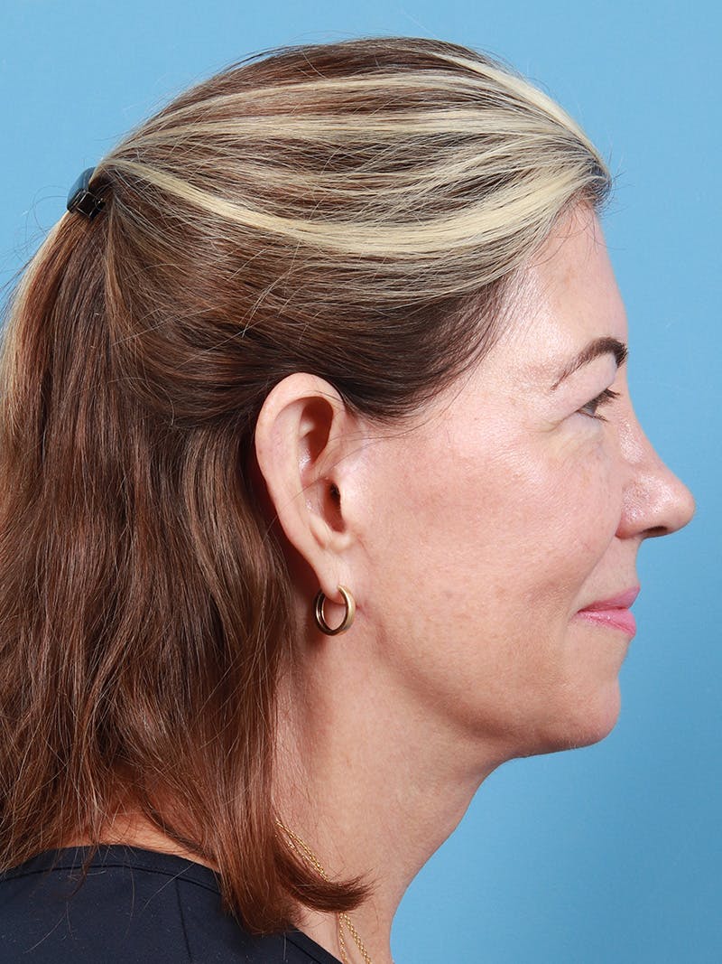 Neck Lift Before & After Gallery - Patient 747437 - Image 4