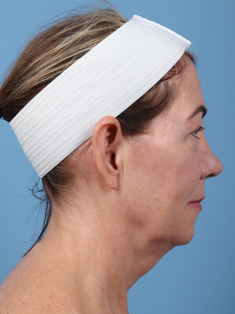 Neck Lift Before & After Gallery - Patient 747437 - Image 3