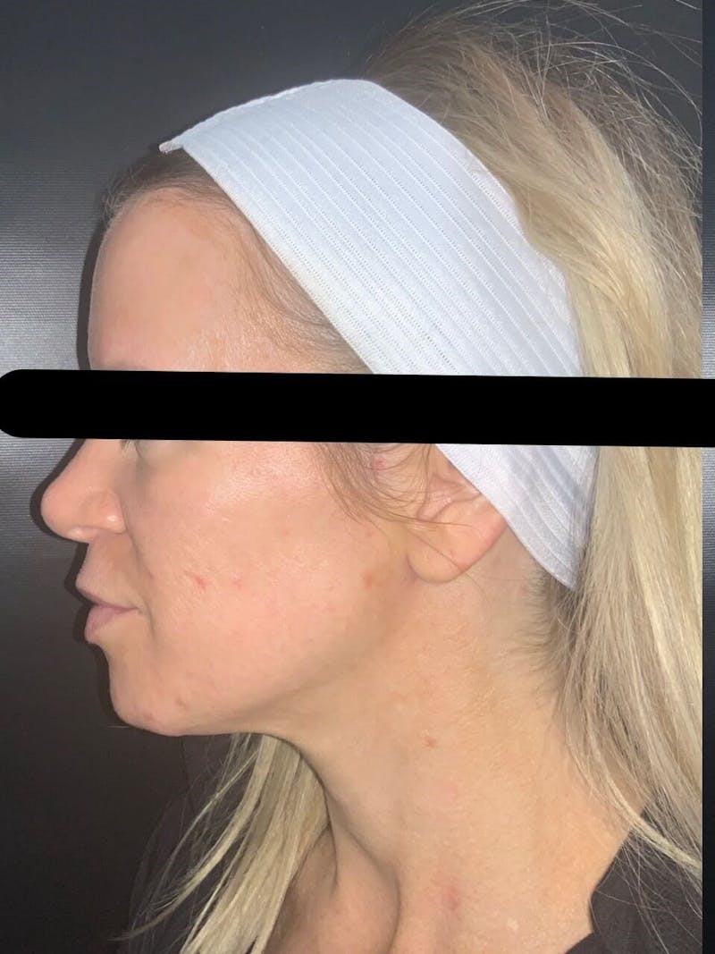 Face Before & After Gallery - Patient 123453 - Image 1