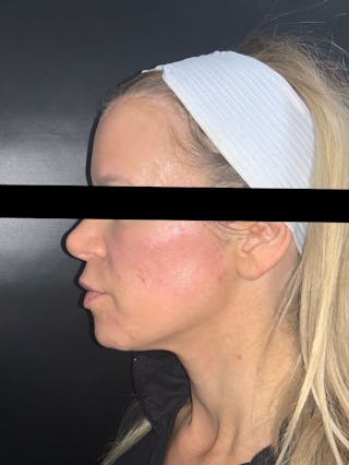Face Before & After Gallery - Patient 123453 - Image 2
