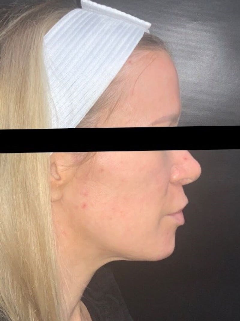 Face Before & After Gallery - Patient 123453 - Image 3