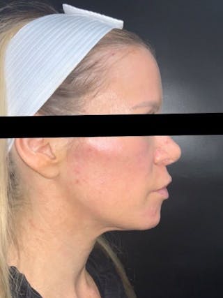 Face Before & After Gallery - Patient 123453 - Image 4