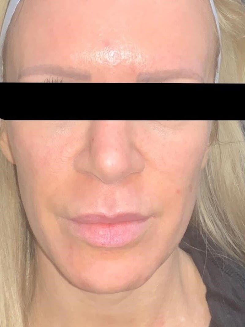 Face Before & After Gallery - Patient 123453 - Image 5