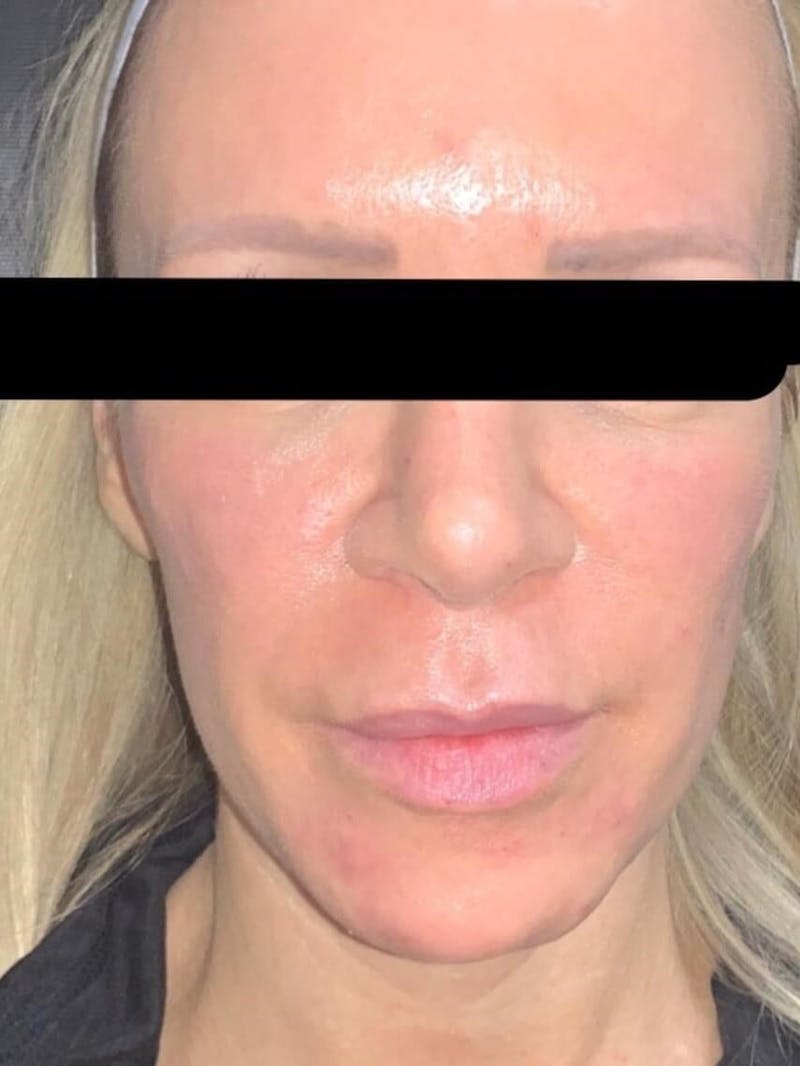 Face Before & After Gallery - Patient 123453 - Image 6