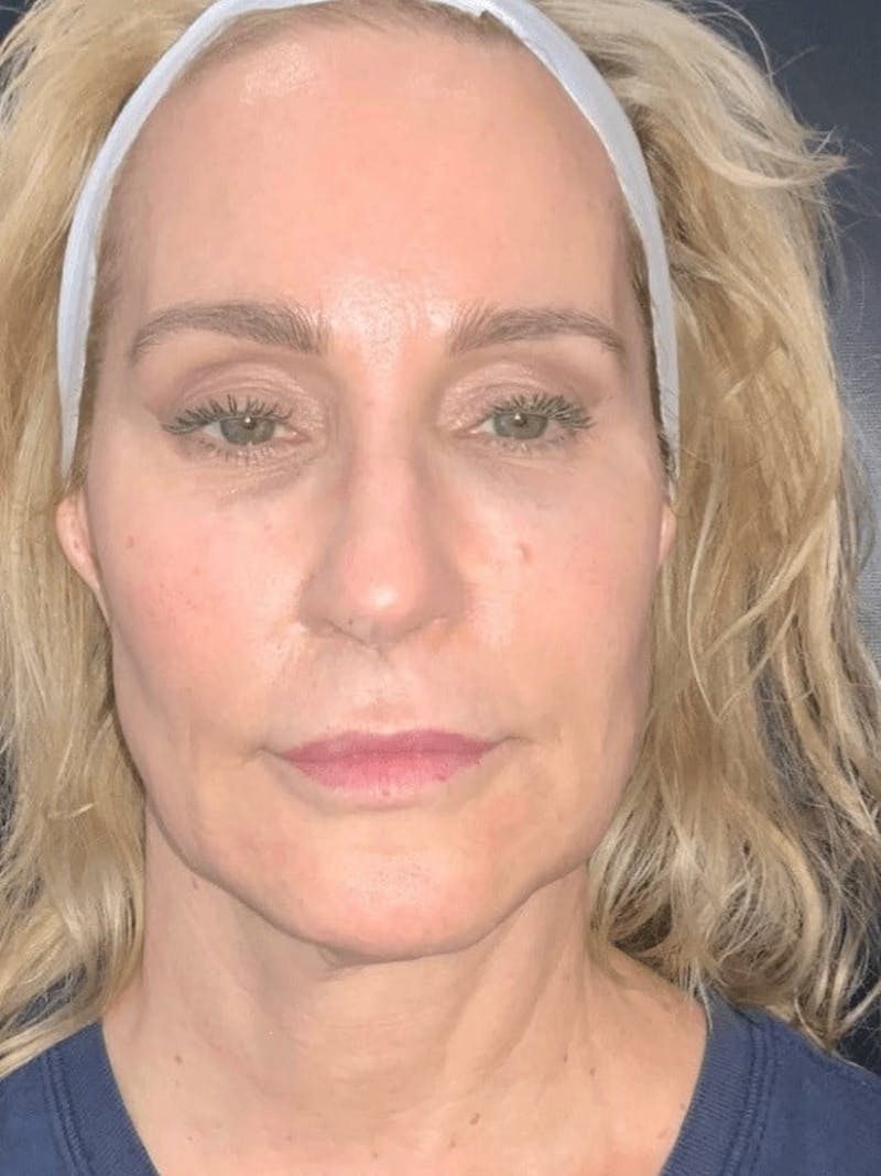 Face Before & After Gallery - Patient 234873 - Image 1