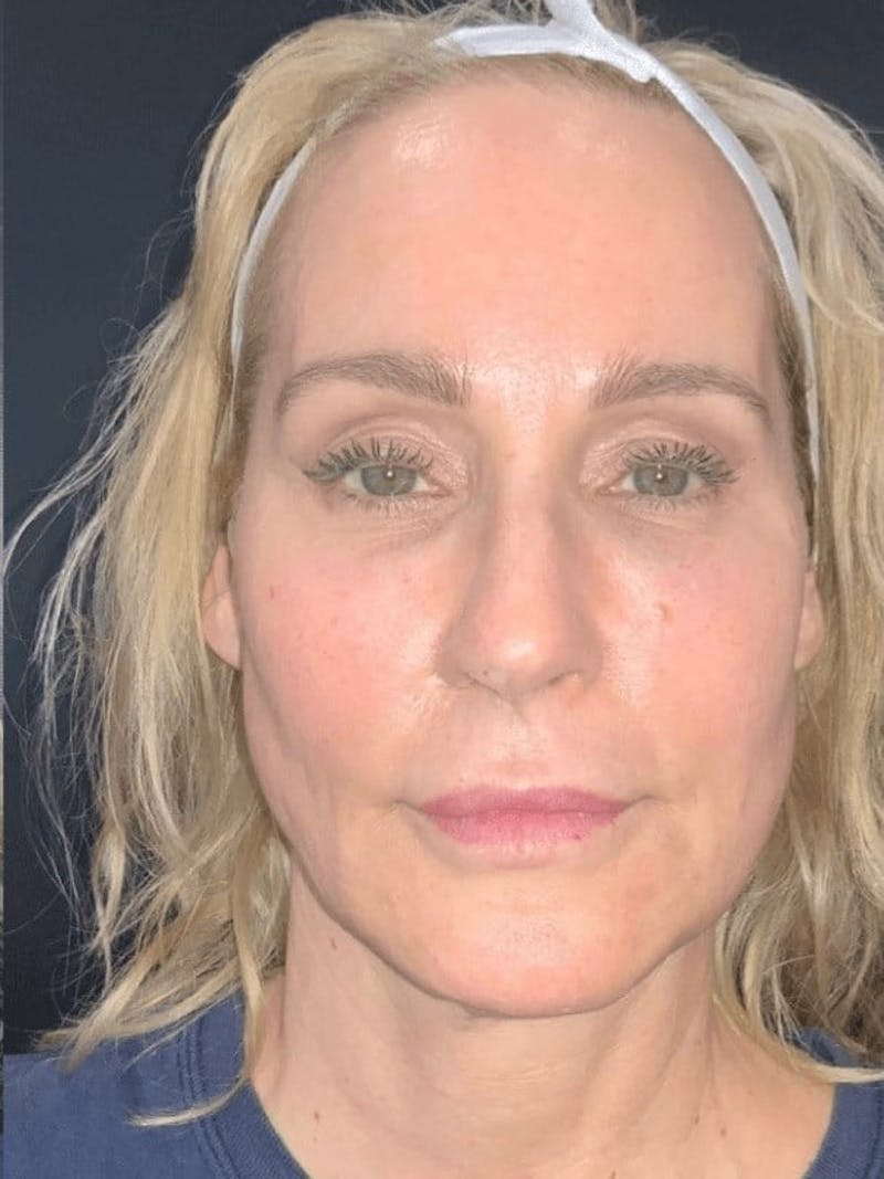 Face Before & After Gallery - Patient 234873 - Image 2