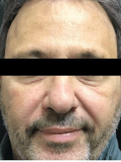 Face Before & After Gallery - Patient 582270 - Image 1
