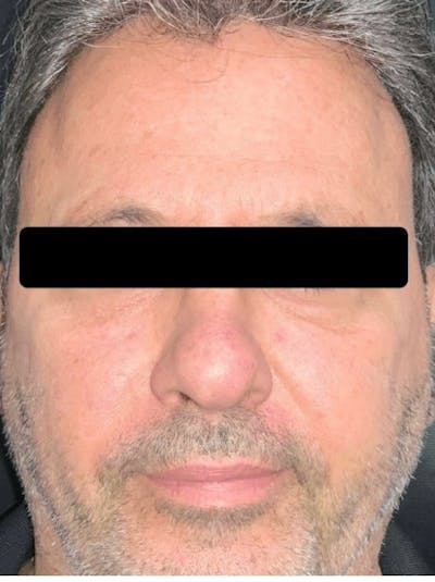 Face Before & After Gallery - Patient 582270 - Image 2