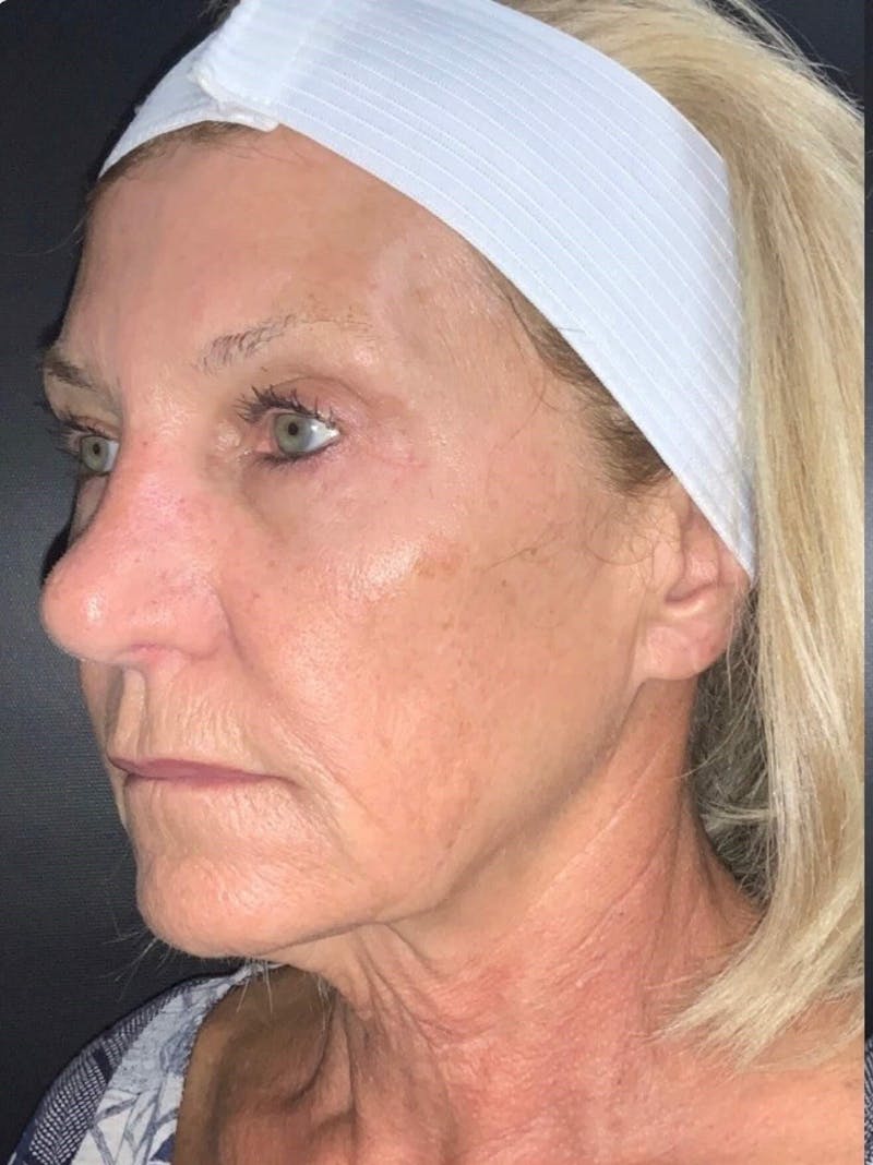 Face Before & After Gallery - Patient 413007 - Image 1