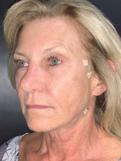 Face Before & After Gallery - Patient 413007 - Image 2