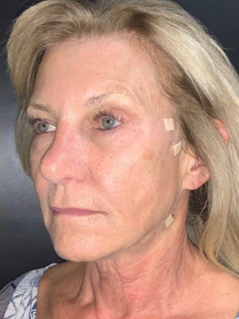 Face Before & After Gallery - Patient 413007 - Image 2