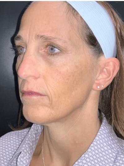 Face Before & After Gallery - Patient 264834 - Image 1