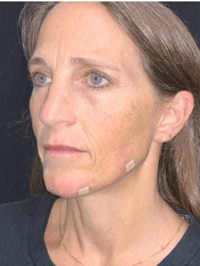 Face Before & After Gallery - Patient 264834 - Image 2