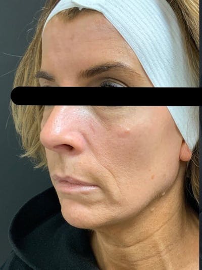 Face Before & After Gallery - Patient 408778 - Image 1