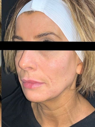 Face Before & After Gallery - Patient 408778 - Image 2