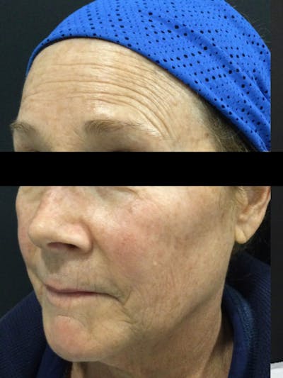 Face Before & After Gallery - Patient 668958 - Image 1