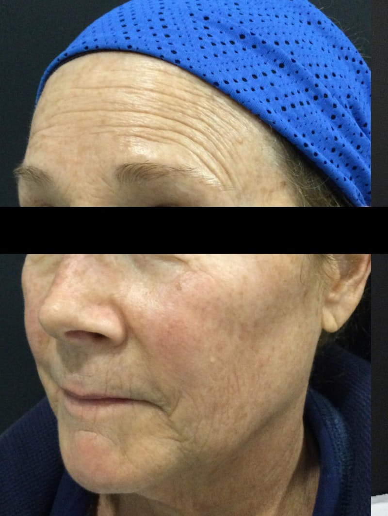 Face Before & After Gallery - Patient 668958 - Image 1