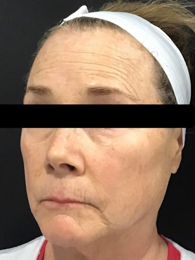Face Before & After Gallery - Patient 668958 - Image 2